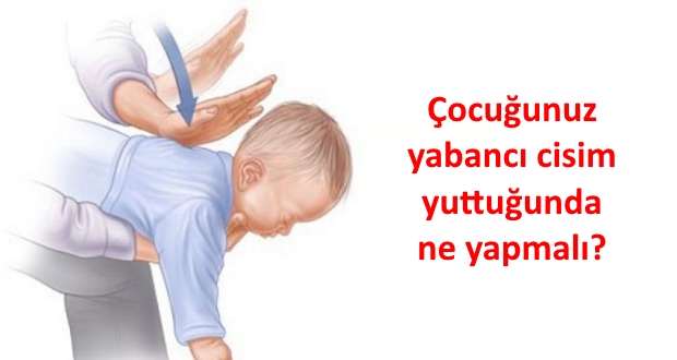 yabanci cisim yutan cocuk ne yapmali